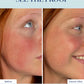Redness Corrector